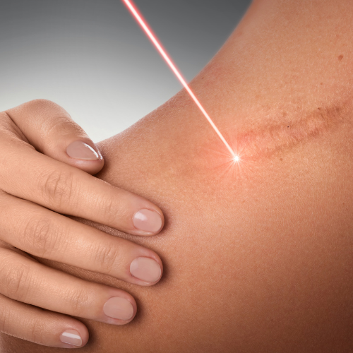 Laserterapia para Cicatrização: Como Esse Tratamento Acelera a Recuperação?